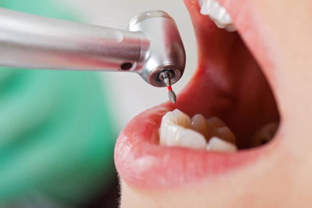 Best Knocked-Out Tooth (Avulsed Tooth) Treatment in Rutherford, PA